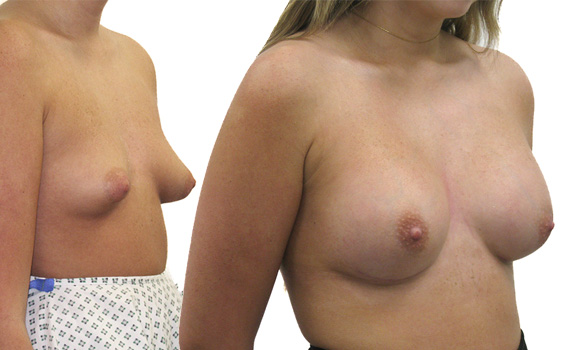 photos of tublar breast correction before and after surgery.
